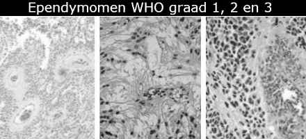 Ependymomen hersentumor