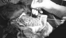 Neurochirurg operatie